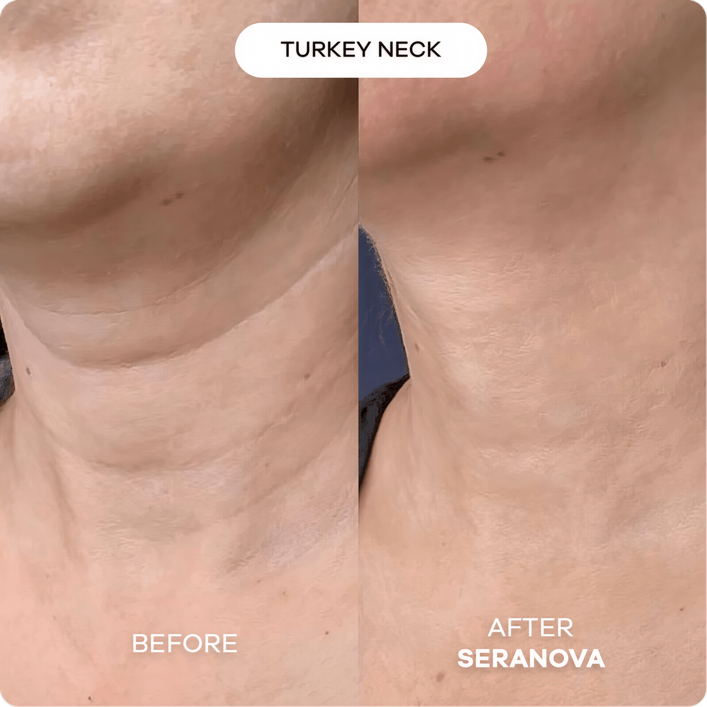 Seranova Micro Infusion Hyaluronic Acid Collagen Peptide 3 Month Supply