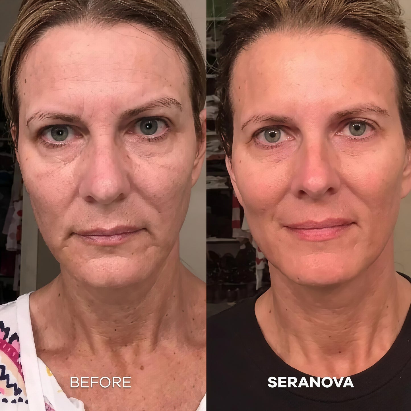 Seranova Micro Infusion Hyaluronic Acid Collagen Peptide 3 Month Supply