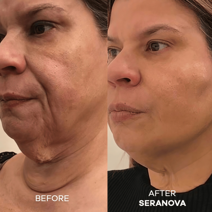 Seranova Micro Infusion Hyaluronic Acid Collagen Peptide 3 Month Supply